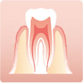 歯周病（歯槽膿漏）の原因